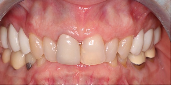 Discolored front teeth before cosmetic dentistry