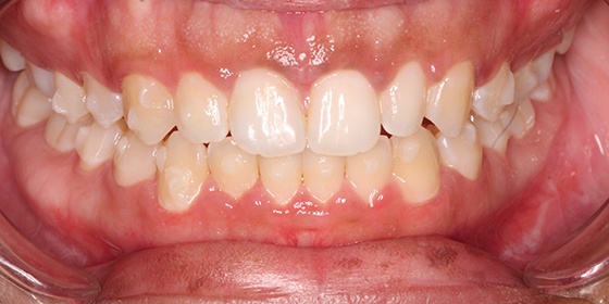 Perfectly aligned smile after Invisalign treatment