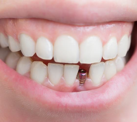 Closeup of dental implant post-op in Lady Lake